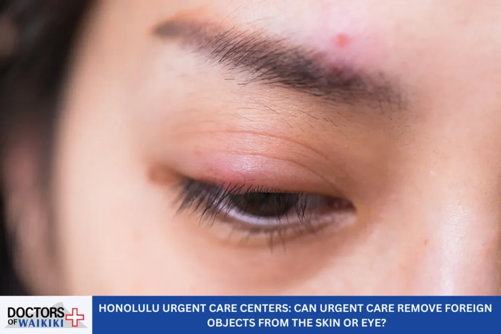 Honolulu Urgent Care Centers: Can Urgent Care Remove Foreign Objects From the Skin or Eye?