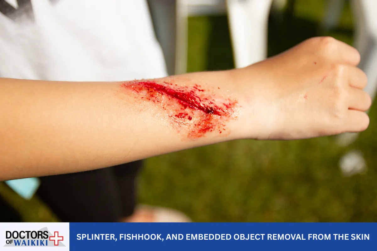 Splinter, Fishhook, and Embedded Object Removal from the Skin