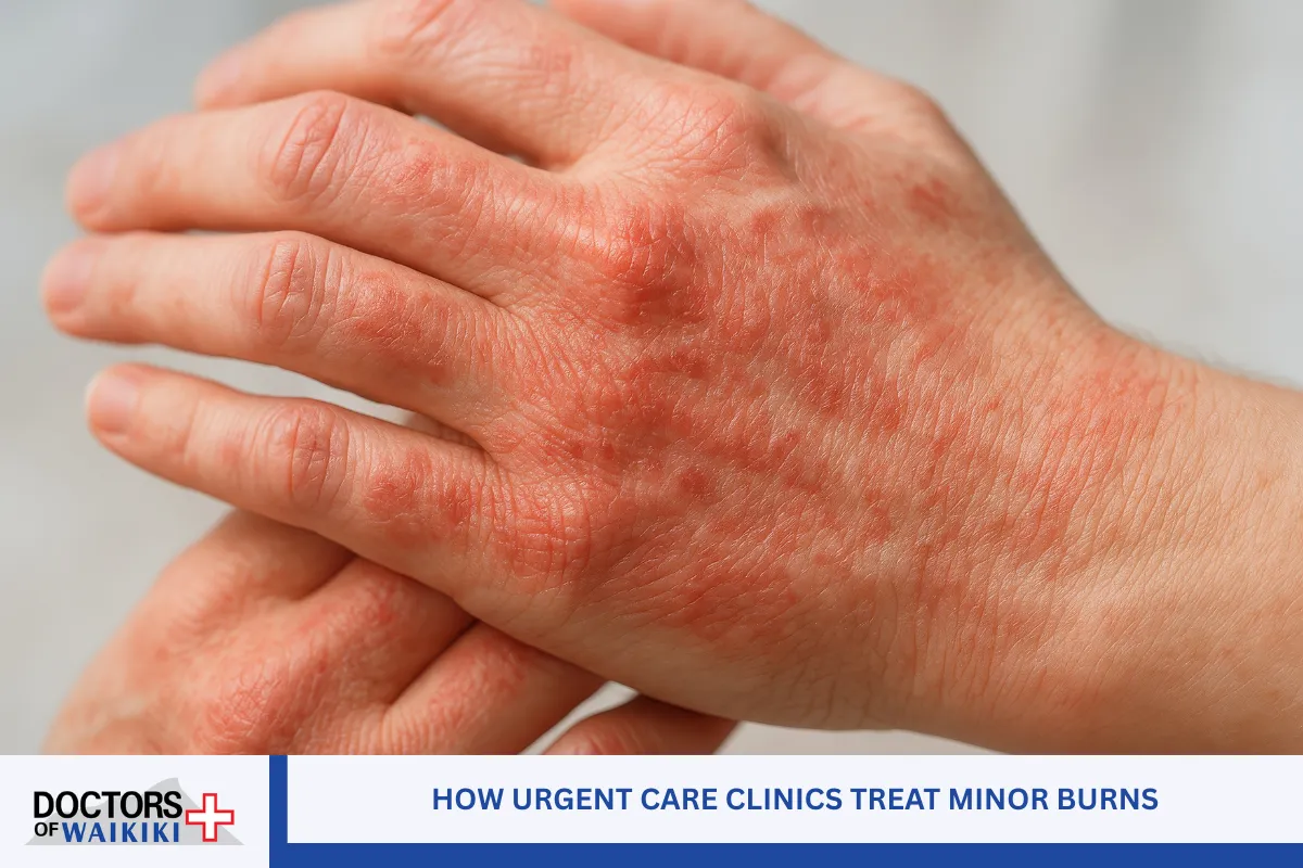 How Urgent Care Clinics Treat Minor Burns