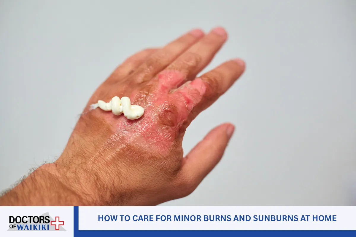 How to Care for Minor Burns and Sunburns at Home