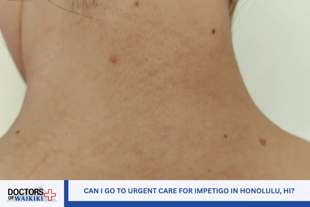 Can I Go to Urgent Care for Impetigo in Honolulu, HI?