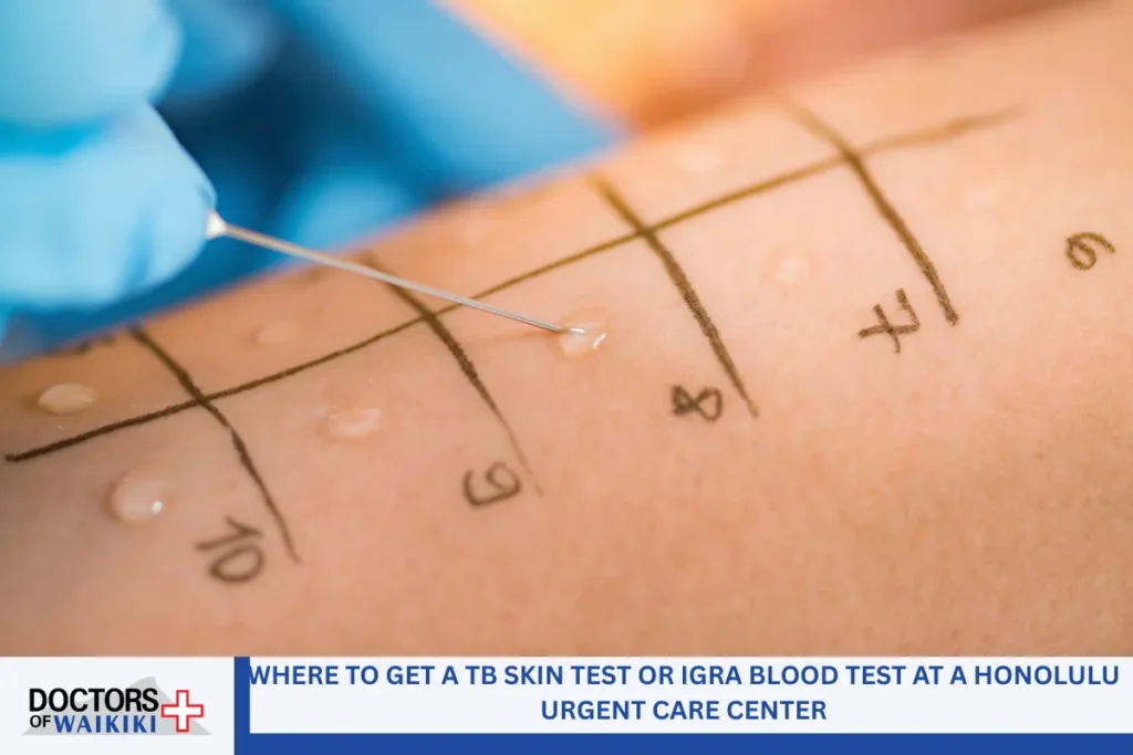Where to Get a TB Skin Test or IGRA Blood Test at a Honolulu Urgent Care Center